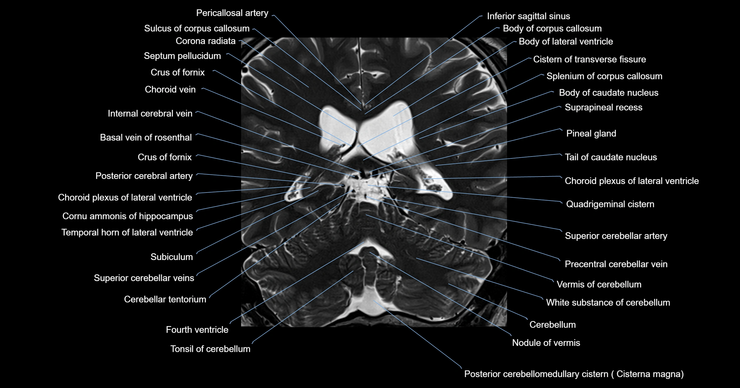 MRI brainstem & basal ganglia anatomy labelled 3T MRI images -img-00001-00032.webp
